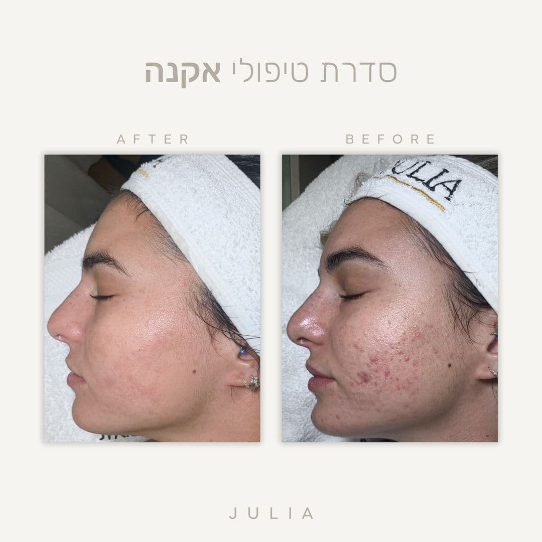 לפני ואחרי טיפול אקנה