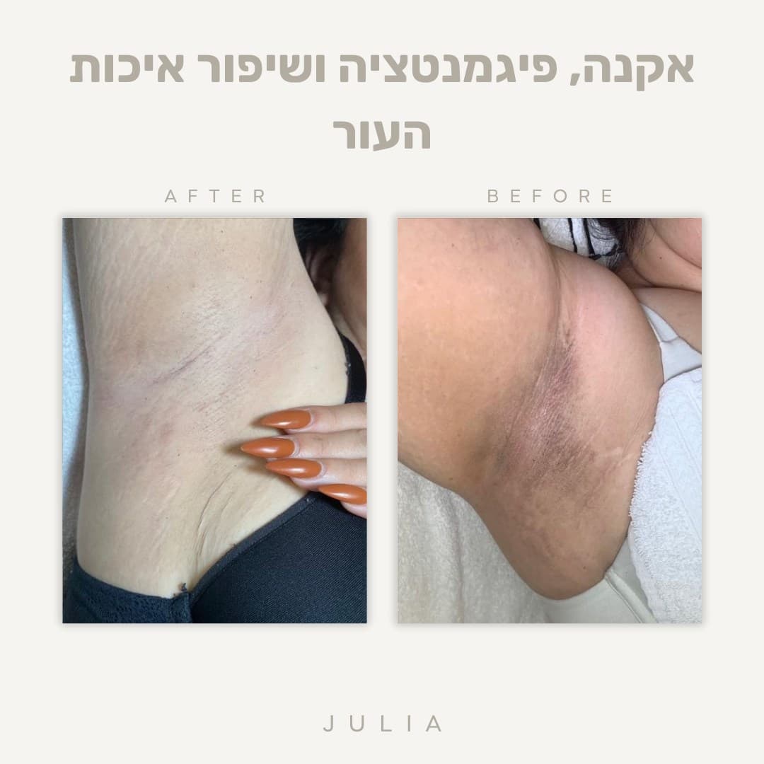 לפני ואחרי טיפול אקנה ושיפור איכות העור